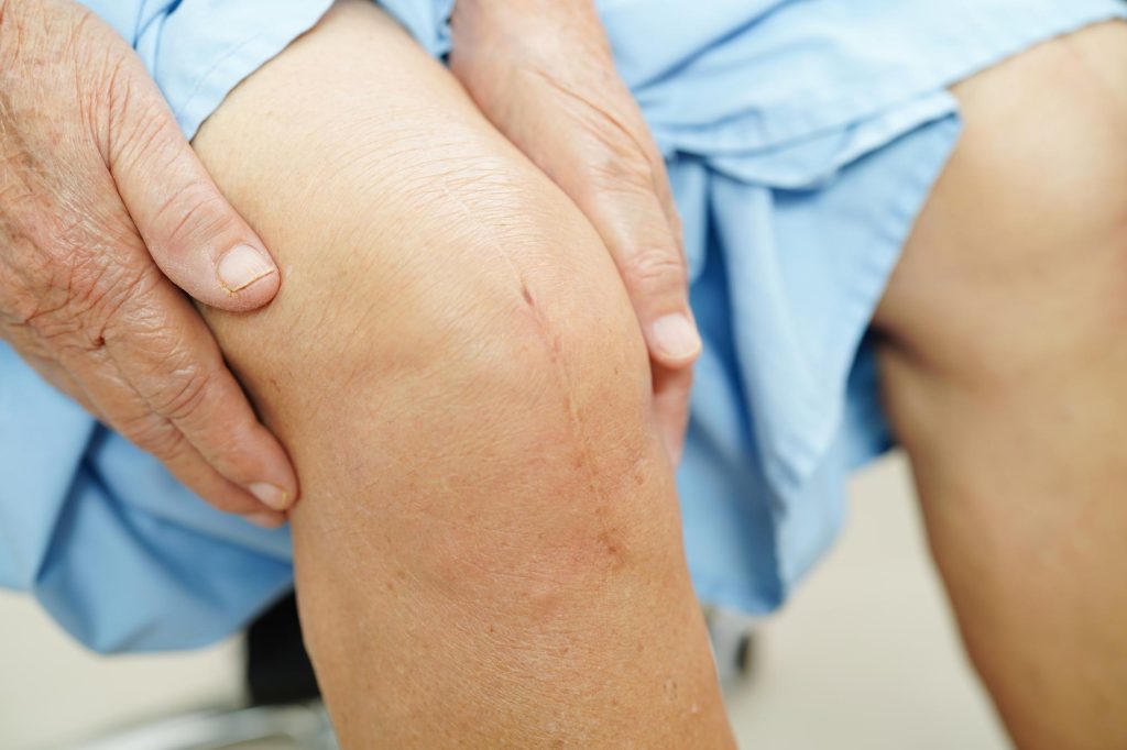 blizna po endoprotezie kolana