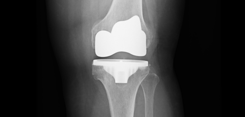 Endoprotezoplastyka całkowita stawu kolanowego 2
