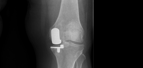 Endoprotezoplastyka jednoprzedziałowa stawu kolanowego 3