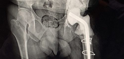 Operacje rewizyjne po endoprotezoplastyce stawu biodrowego 4